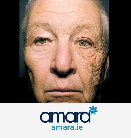 Weather Damaged Skin - Uneven Face - Botox Treatments Dublin