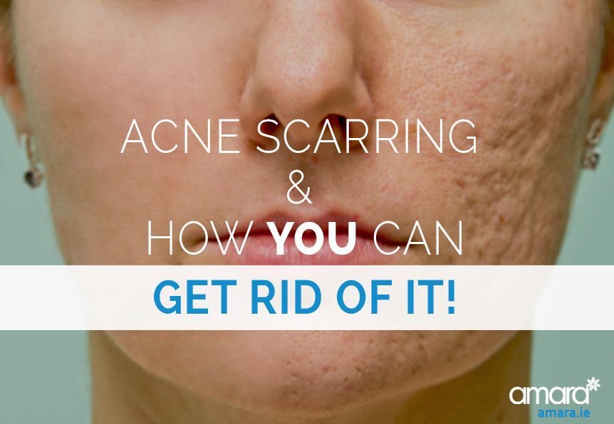 Acne Scarring Treatment Dublin - Amara
