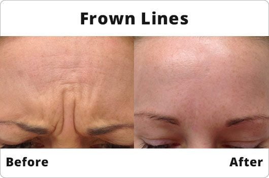 Before and After - Frown Lines - Botox Treatment