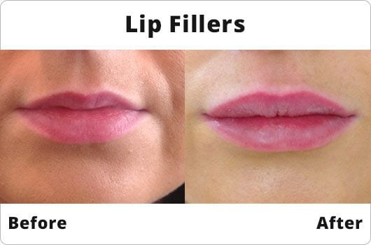 Before and After - Lip Fillers