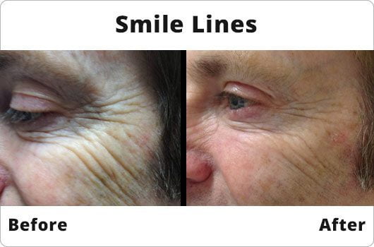 Before and After - Smile Lines Botox Treatments