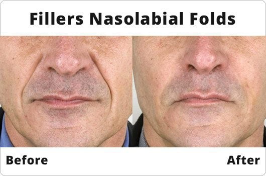 before after photos testimonials lip fillers dublin amara before after auto detailing pressure washing photos for a flyer