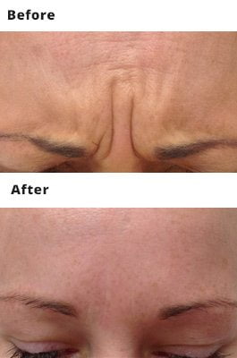 Anti Wrinkle Injection Prices Dublin - Amara Skincare Clinics
