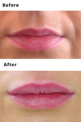 Lip Fillers Prices Dublin - Amara Skincare Clinic