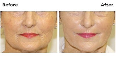 PRP Treatment Price - Vampire Facial Dublin - Amara