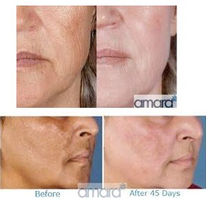 Zo Skin Health - Zein Obagi Skincare Treatments - Before and After