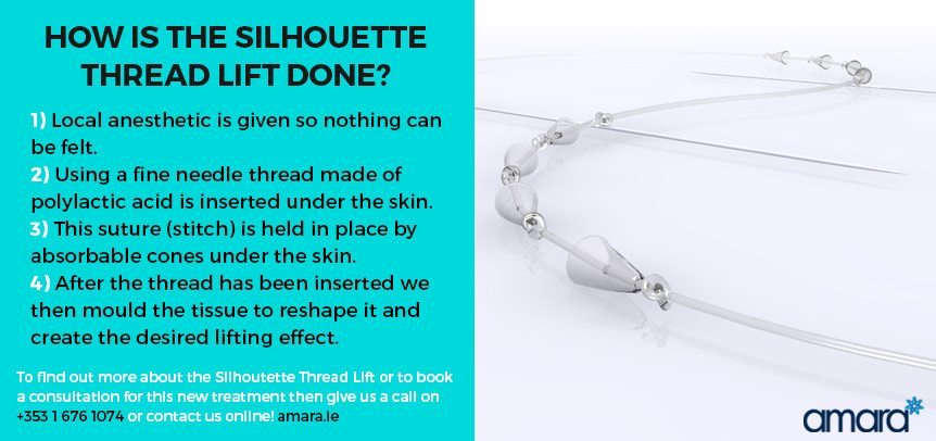 How Is the Silhouette Thread Lift Done