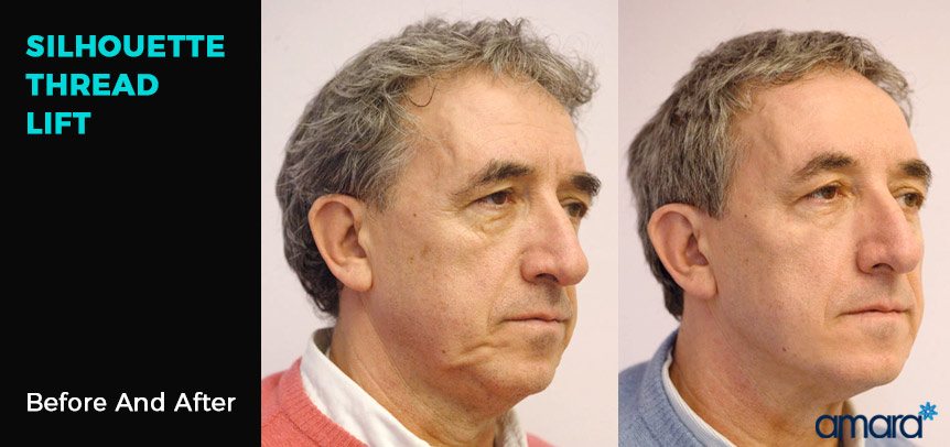 Silhouette Thread  Lift -  Before And After Photos