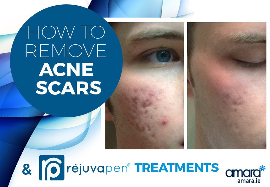 How to Remove Acne Scars - Amara Dublin